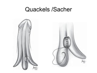 Quackels /Sacher
 