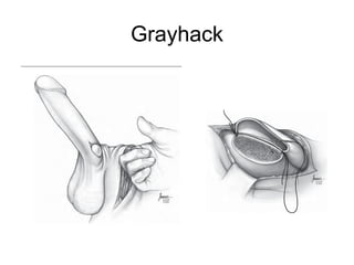 Grayhack
 