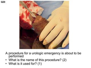 A procedure for a urologic emergency is about to be
performed
• What is the name of this procedure? (2)
• What is it used for? (1)
Q20
 