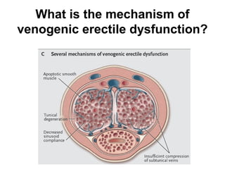 What is the mechanism of
venogenic erectile dysfunction?
 