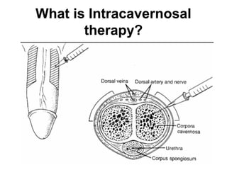 What is Intracavernosal
therapy?
 