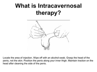 What is Intracavernosal
therapy?
Locate the area of injection. Wipe off with an alcohol swab. Grasp the head of the
penis, not the skin. Position the penis along your inner thigh. Maintain traction on the
head after cleaning the side of the penis.
 