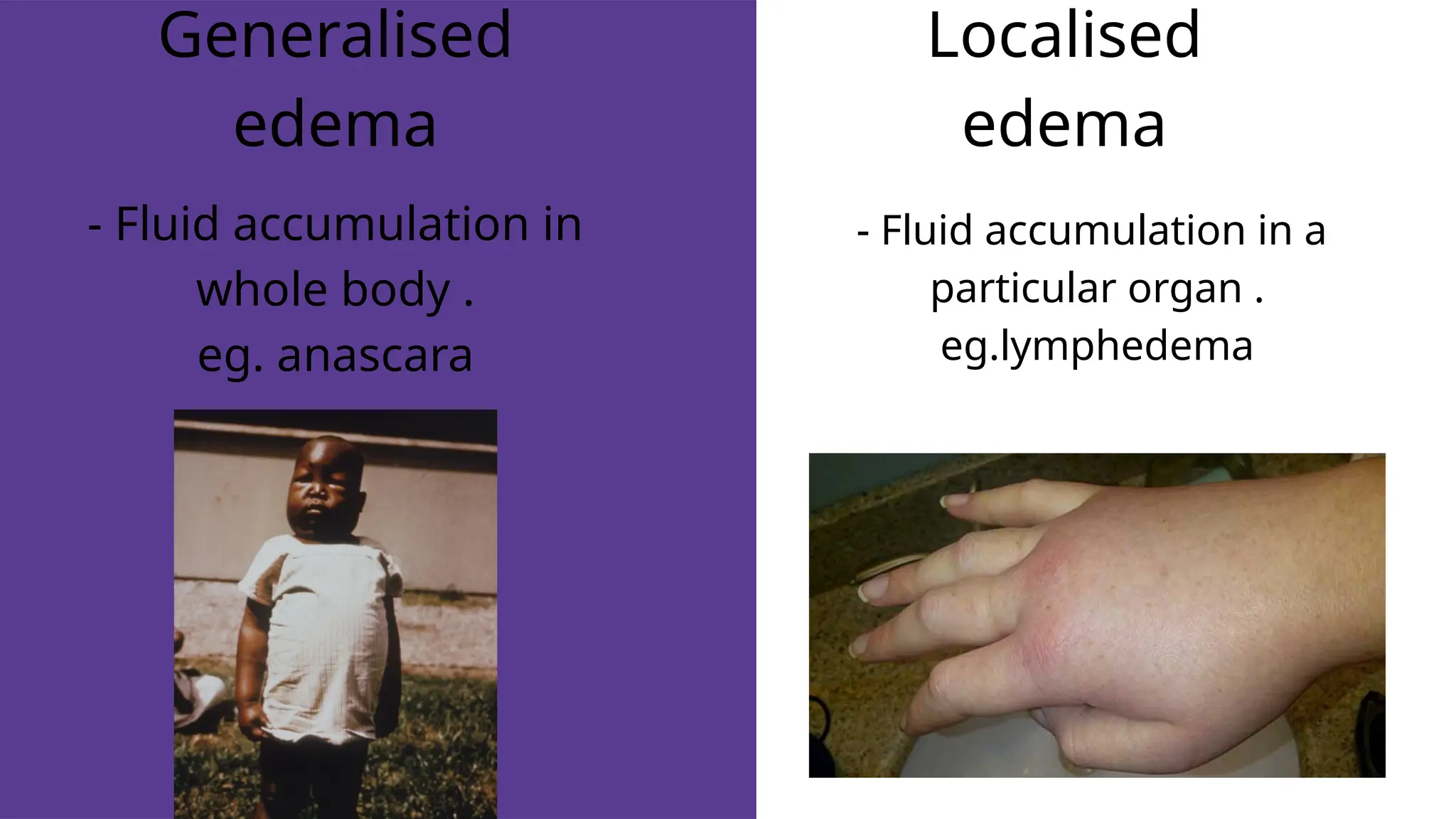Generalised
edema
Localised
edema
- Fluid accumulation in
whole body .
eg. anascara
- Fluid accumulation in a
particular organ .
eg.lymphedema
 