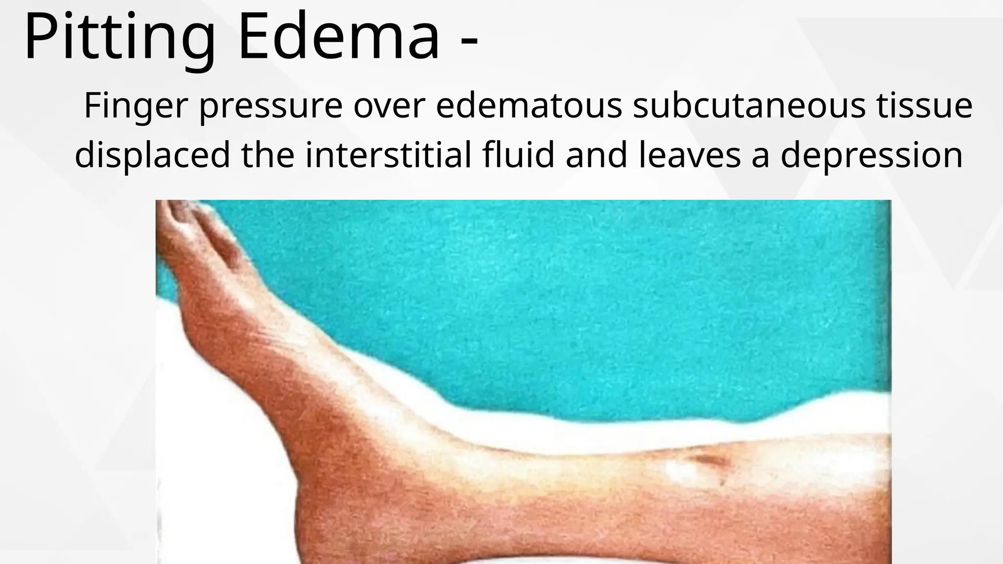 Finger pressure over edematous subcutaneous tissue
displaced the interstitial fluid and leaves a depression
Pitting Edema -
 