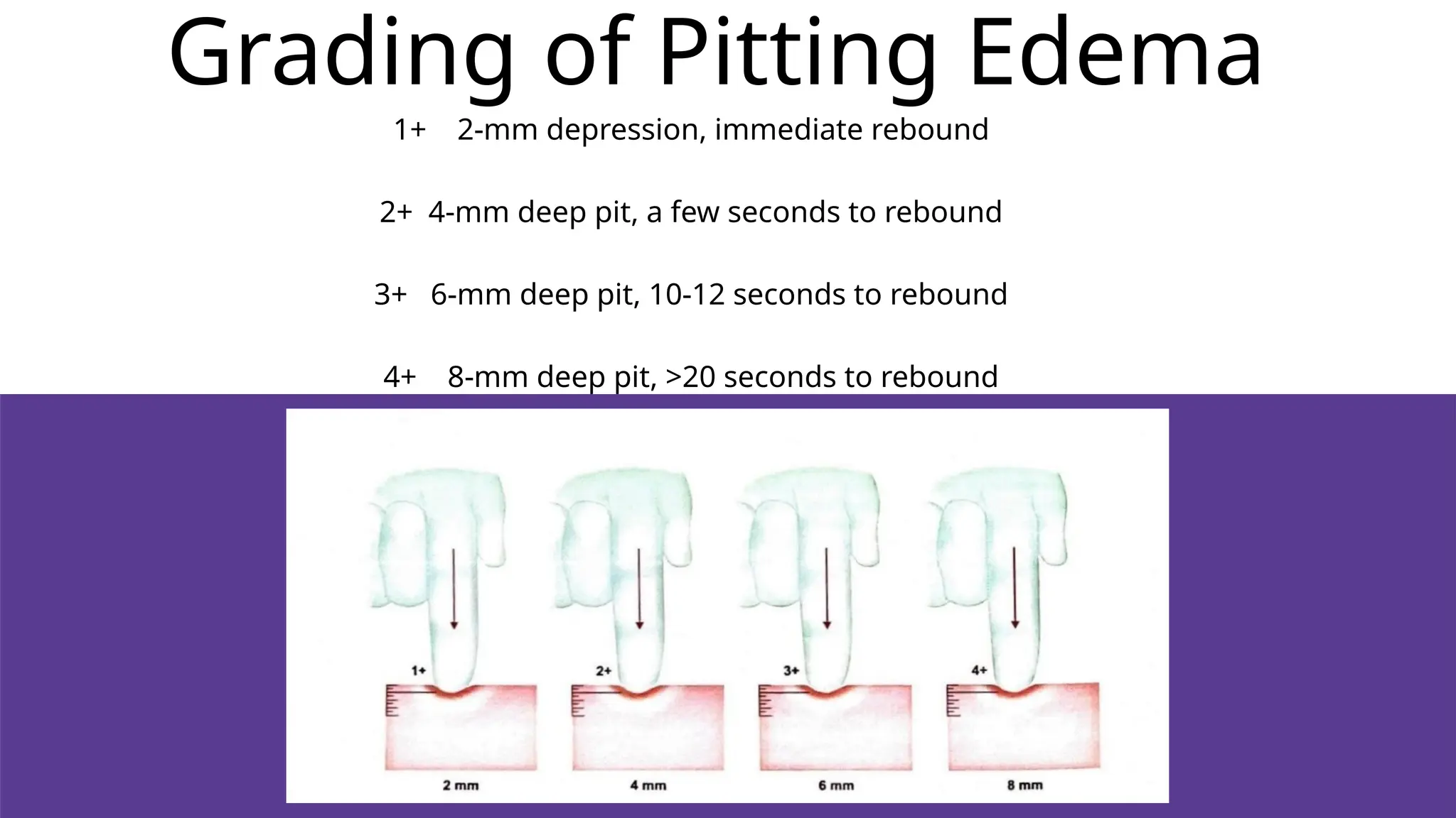 1+ 2-mm depression, immediate rebound
2+ 4-mm deep pit, a few seconds to rebound
3+ 6-mm deep pit, 10-12 seconds to rebound
4+ 8-mm deep pit, >20 seconds to rebound
Grading of Pitting Edema
 