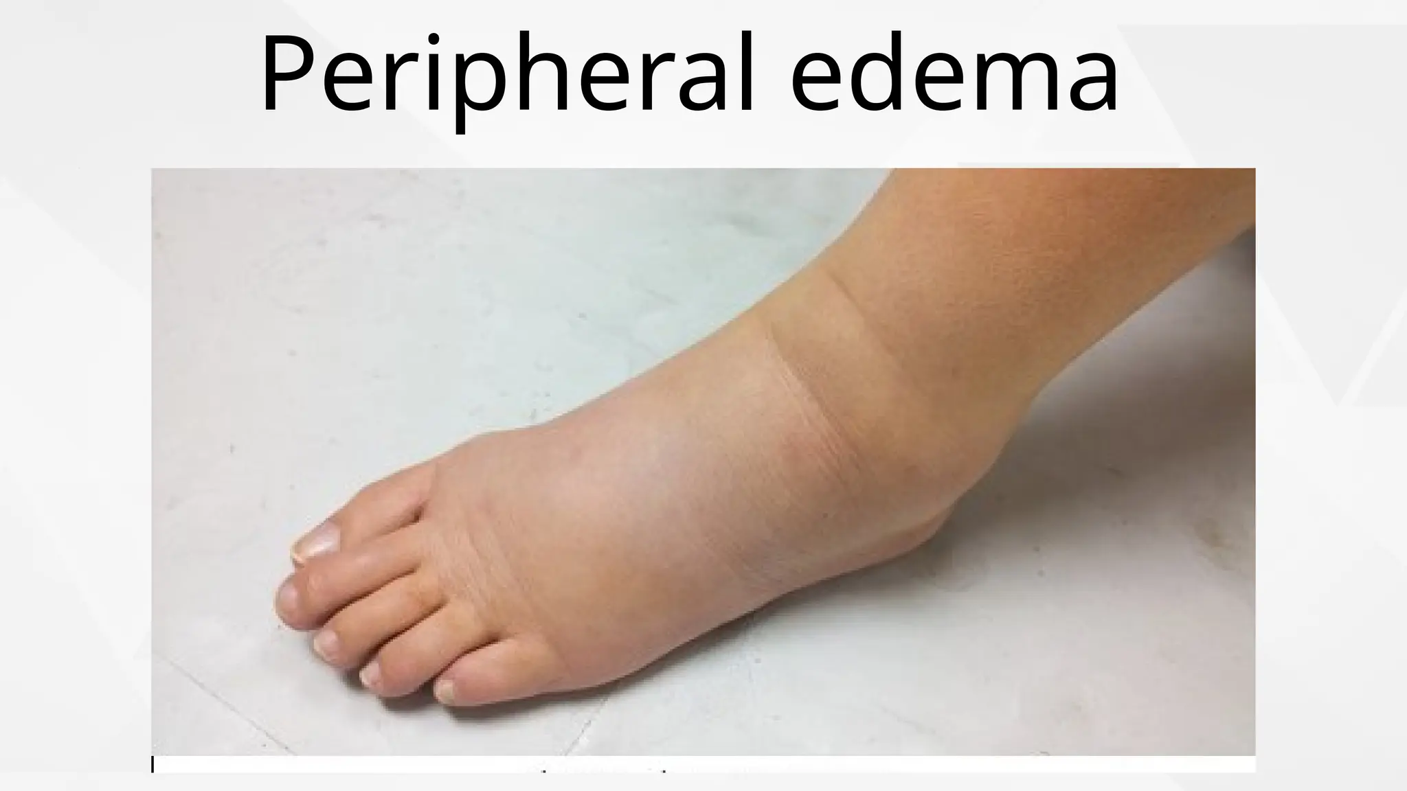 Peripheral edema
 