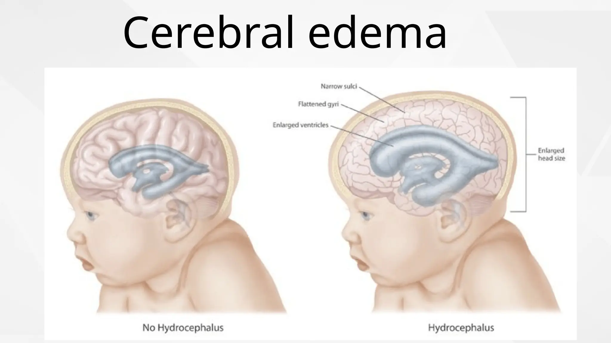 Cerebral edema
 