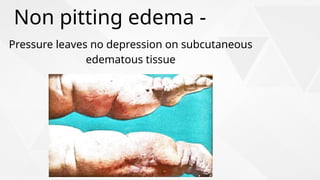 Edema complete details ppt (definition, types).pptx