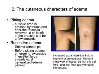 Edema | PPT