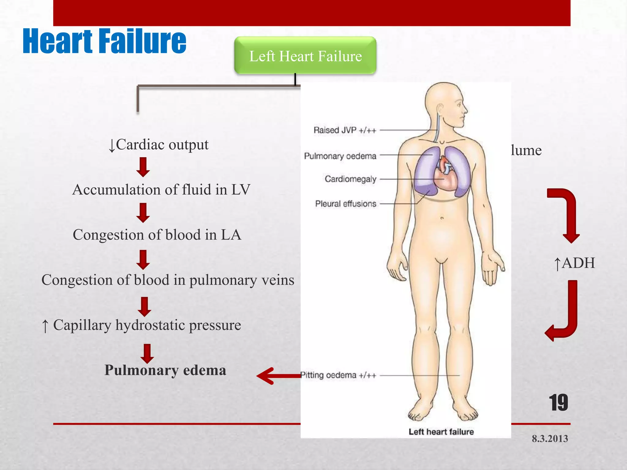 Heart Failure                       Left Heart Failure




           ↓Cardiac output                        ↓Effective arterial blood volume

     Accumulation of fluid in LV                         ↓Renal perfusion

      Congestion of blood in LA                      RAA System activation
                                                                                     ↑ADH
 Congestion of blood in pulmonary veins                   ↑aldosterone

 ↑ Capillary hydrostatic pressure                    Salt & water retentions

           Pulmonary edema                                Fluid overload
                                                                                     19
                                                                                8.3.2013
 