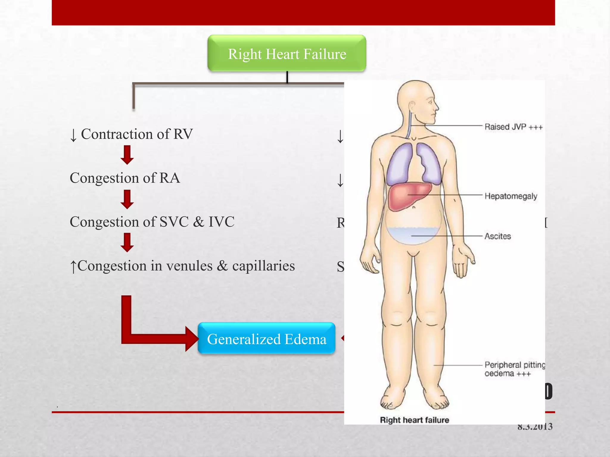 Right Heart Failure




    ↓ Contraction of RV                       ↓Cardiac output from LV

    Congestion of RA                          ↓Arterial Blood Volume

    Congestion of SVC & IVC                   RAA System activation     ↑ADH

    ↑Congestion in venules & capillaries      Salt & Water retentions



                          Generalized Edema



.
                                                                            20
                                                                         8.3.2013
 