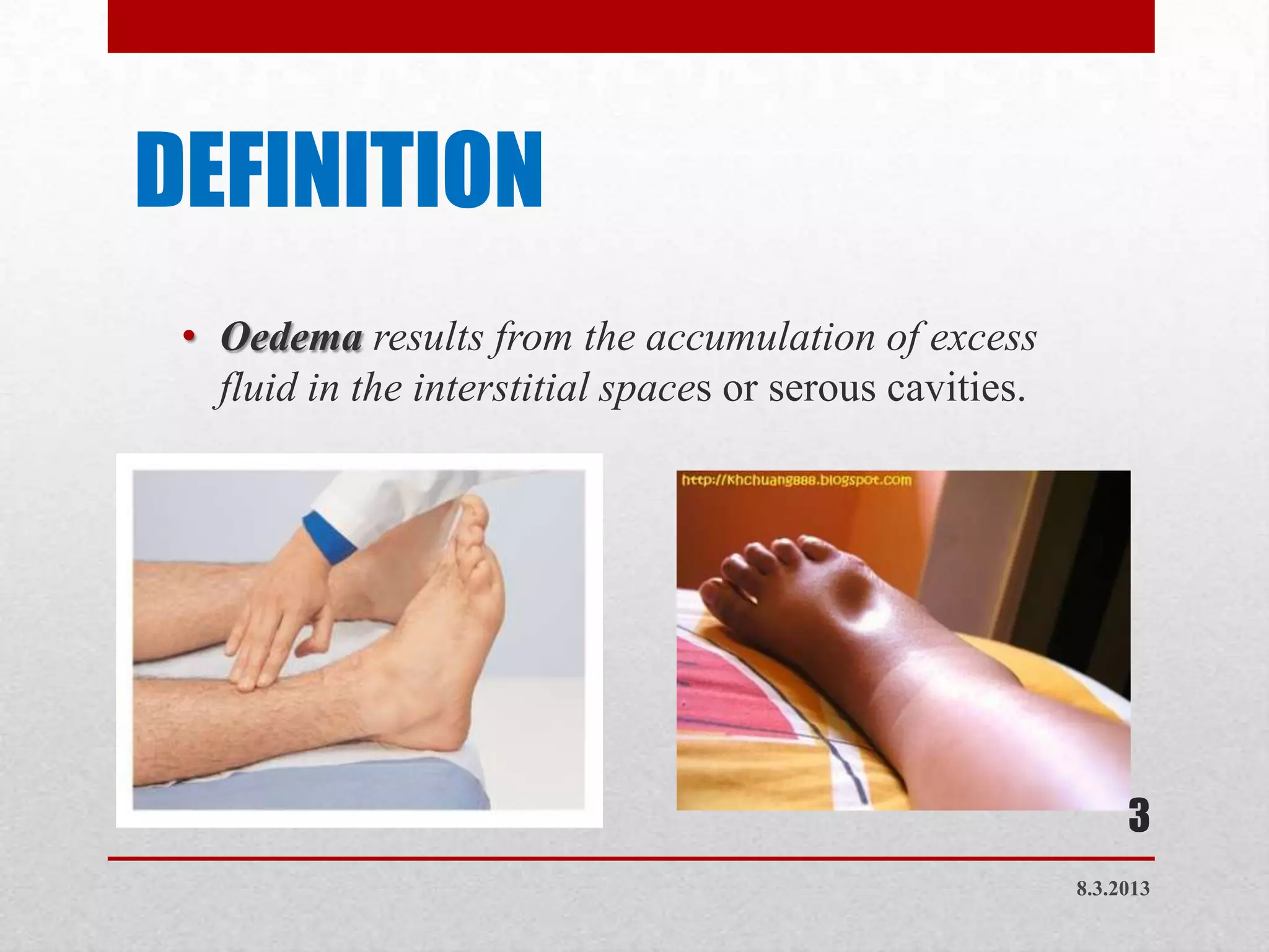 DEFINITION
 • Oedema results from the accumulation of excess
   fluid in the interstitial spaces or serous cavities.




                                                               3
                                                          8.3.2013
 