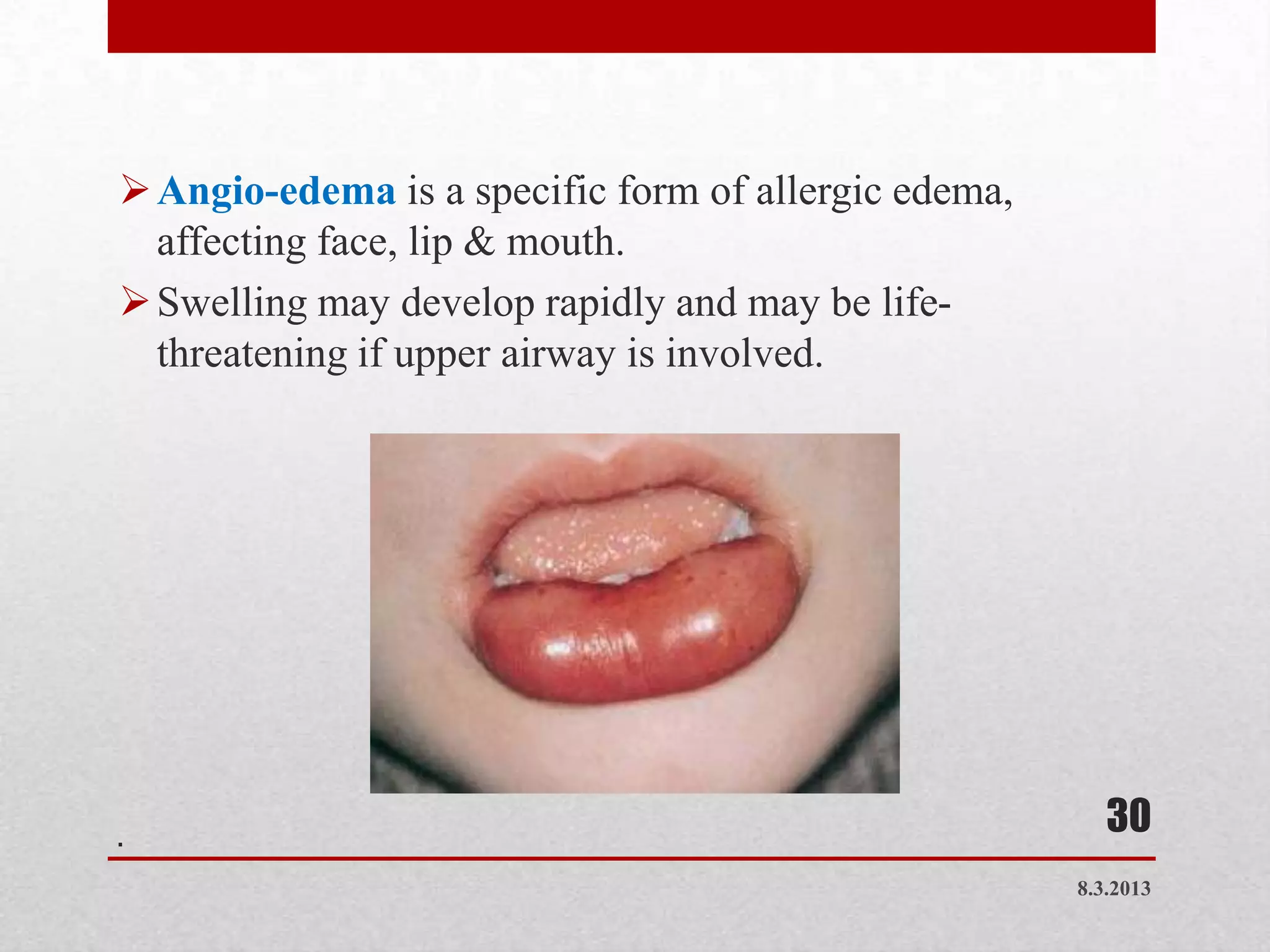  Angio-edema is a specific form of allergic edema,
  affecting face, lip & mouth.
 Swelling may develop rapidly and may be life-
  threatening if upper airway is involved.




.
                                                         30
                                                      8.3.2013
 