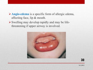  Angio-edema is a specific form of allergic edema,
  affecting face, lip & mouth.
 Swelling may develop rapidly and may be life-
  threatening if upper airway is involved.




.
                                                         30
                                                      8.3.2013
 