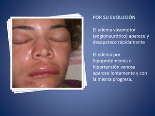 Edema | PPTX