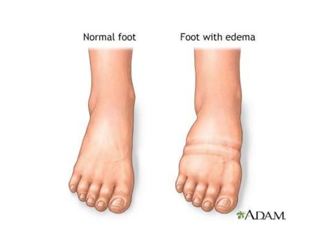 edema shoes for swollen feet