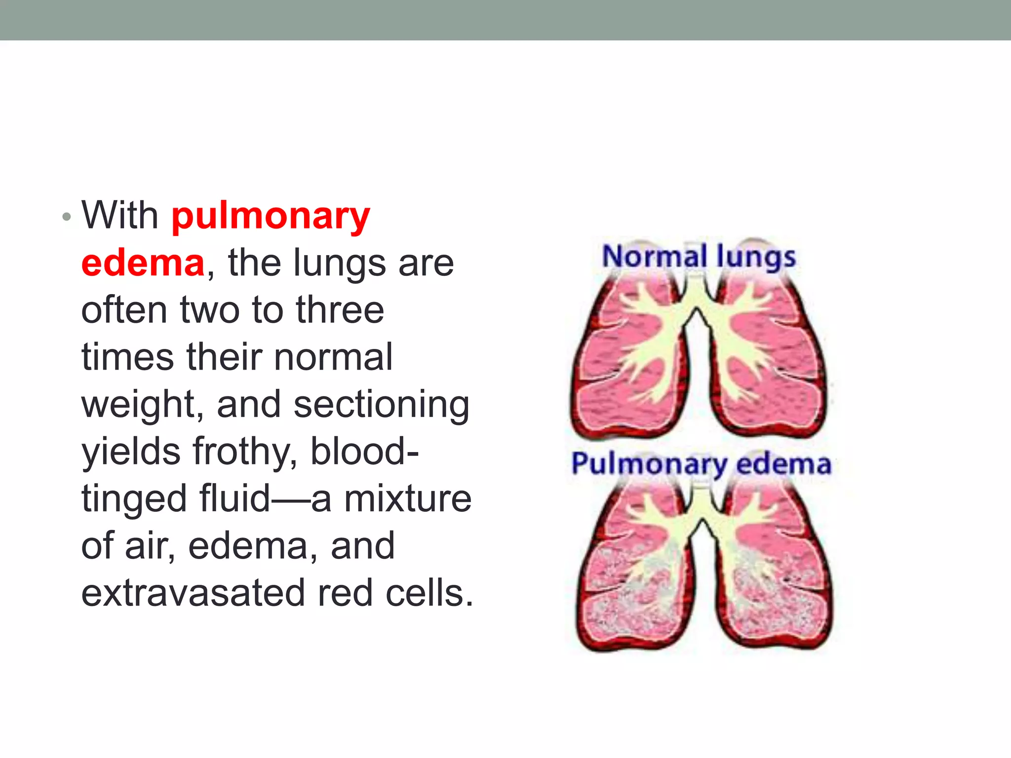 • With pulmonary
edema, the lungs are
often two to three
times their normal
weight, and sectioning
yields frothy, blood-
tinged fluid—a mixture
of air, edema, and
extravasated red cells.
 