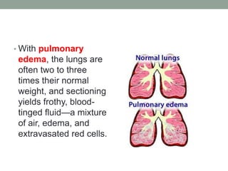 • With pulmonary
edema, the lungs are
often two to three
times their normal
weight, and sectioning
yields frothy, blood-
tinged fluid—a mixture
of air, edema, and
extravasated red cells.
 