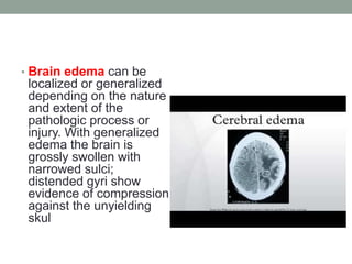 • Brain edema can be
localized or generalized
depending on the nature
and extent of the
pathologic process or
injury. With generalized
edema the brain is
grossly swollen with
narrowed sulci;
distended gyri show
evidence of compression
against the unyielding
skul
 