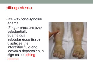 pitting edema
• it’s way for diagnosis
edema
• Finger pressure over
substantially
edematous
subcutaneous tissue
displaces the
interstitial fluid and
leaves a depression, a
sign called pitting
edema
 