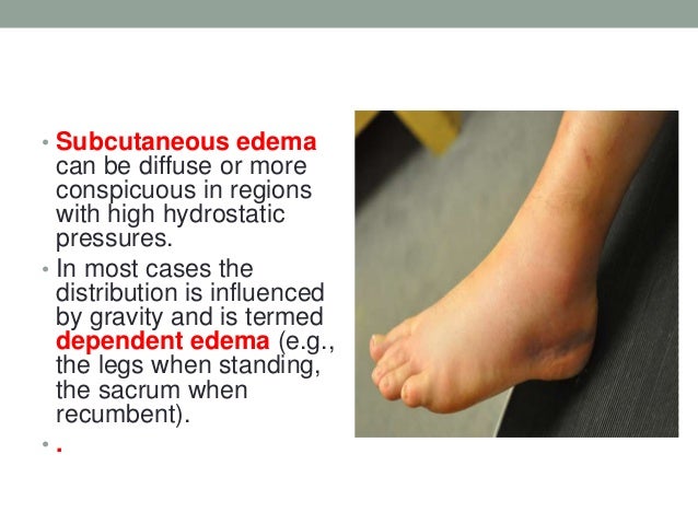 edema