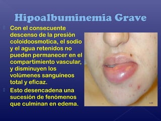 Con el consecuente
descenso de la presión
coloidoosmotica, el sodio
y el agua retenidos no
pueden permanecer en el
compartimiento vascular,
y disminuyen los
volúmenes sanguíneos
total y eficaz.
 Esto desencadena una
sucesión de fenómenos
que culminan en edema.
 