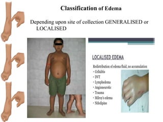 Classification of Edema
Depending upon site of collection GENERALISED or
LOCALISED
 