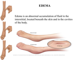 EDEMA
Edema is an abnormal accumulation of fluid in the
interstitial, located beneath the skin and in the cavities
of the body.
 