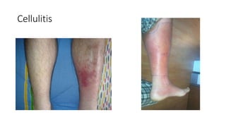 Cellulitis
 