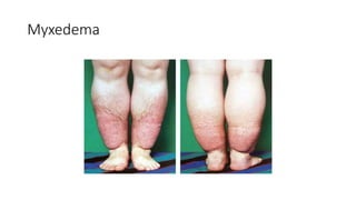 Myxedema
 
