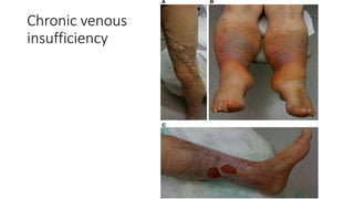 Chronic venous
insufficiency
 