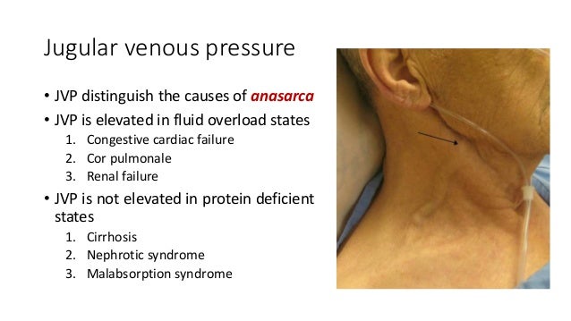 Approach to Pedal Edema (for undergraduates)