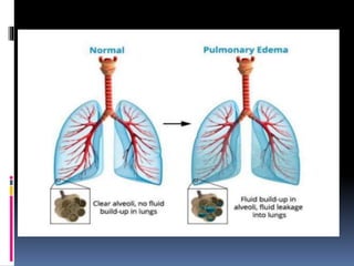 Edema | PPTX