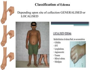 Edema | PPTX