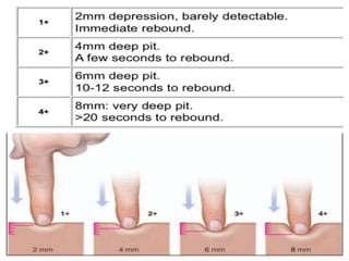 edema-210412060249.pdf