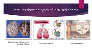 Pictures showing types of localised edema
Normal Brain vs Brain with
Cerebral Edema
Pulmonary Edema Lymphoedema
 