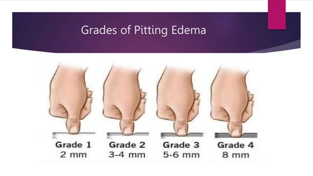 edema .pptx