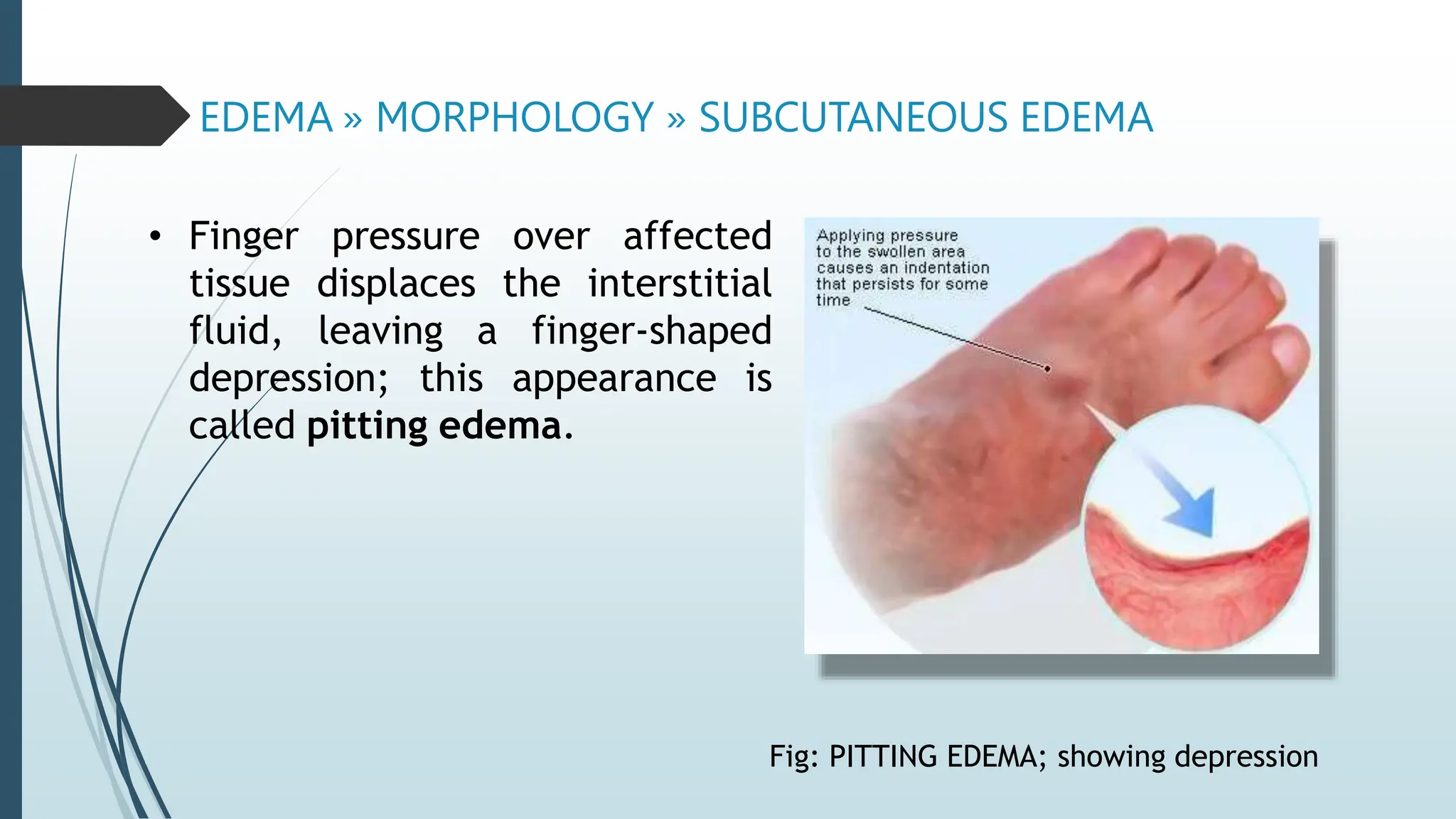 EDEMA » MORPHOLOGY » SUBCUTANEOUS EDEMA
• Finger pressure over affected
tissue displaces the interstitial
fluid, leaving a finger-shaped
depression; this appearance is
called pitting edema.
Fig: PITTING EDEMA; showing depression
 