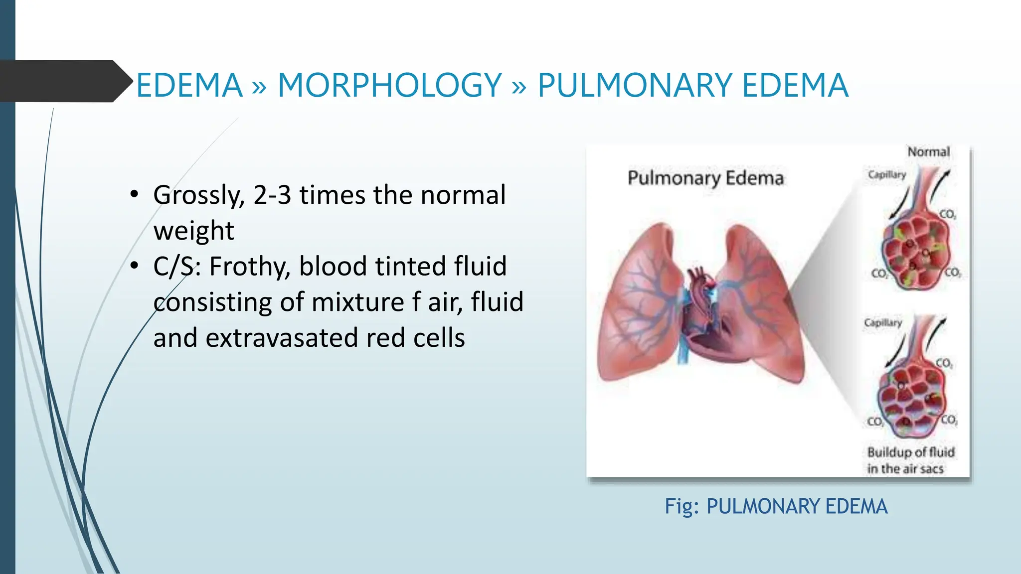 EDEMA » MORPHOLOGY » PULMONARY EDEMA
Fig: PULMONARY EDEMA
• Grossly, 2-3 times the normal
weight
• C/S: Frothy, blood tinted fluid
consisting of mixture f air, fluid
and extravasated red cells
 