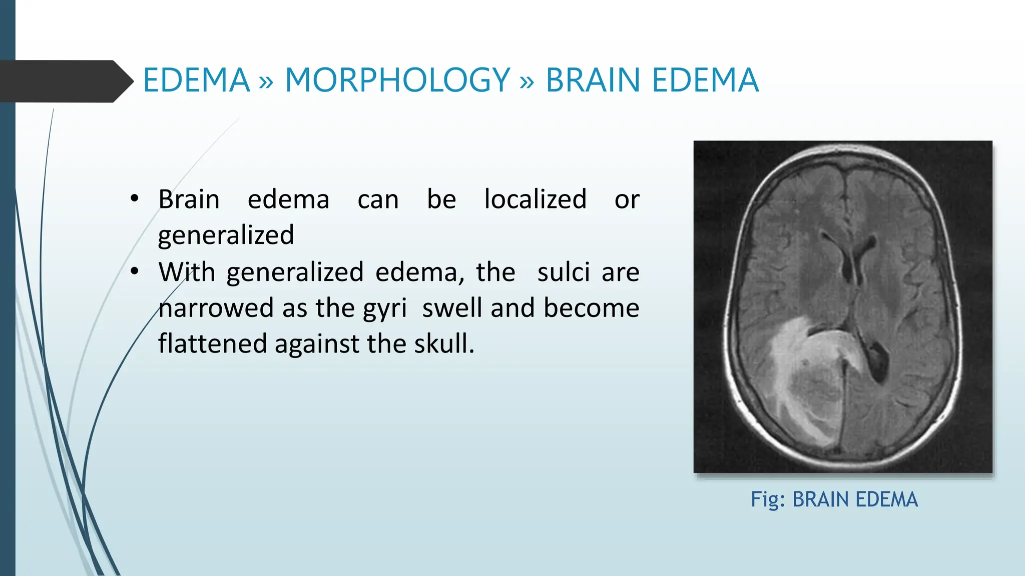 EDEMA » MORPHOLOGY » BRAIN EDEMA
• Brain edema can be localized or
generalized
• With generalized edema, the sulci are
narrowed as the gyri swell and become
flattened against the skull.
Fig: BRAIN EDEMA
 