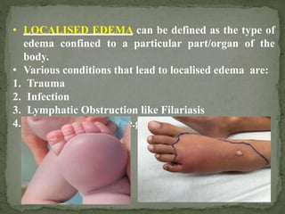 Edema.111111111111111111111111111111pptx | PPTX