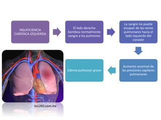INSUFICIENCIA
CARDÍACA IZQUIERDA
El lado derecho
bombea normalmente
sangre a los pulmones
La sangre no puede
escapar de las venas
pulmonares hacia el
lado izquierdo del
corazón
Aumento anormal de
las presiones capilares
pulmonares
Edema pulmonar grave
la1260.com.mx
 