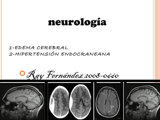 neurología

1-EDEMA CEREBRAL
2-HIPERTENSIÓN ENDOCRANEANA


  Ray Fernández 2008-0660
 