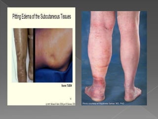 Edema   Fisiologia