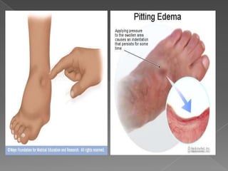 Edema   Fisiologia