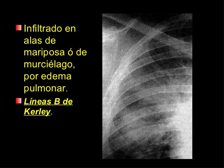 Edema Pulmonar Agudo.