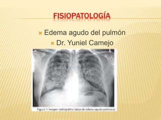 FISIOPATOLOGÍA
 Edema agudo del pulmón
 Dr. Yuniel Camejo
 