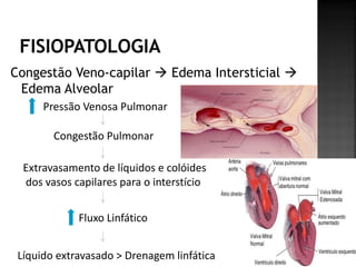 Congestão Veno-capilar  Edema Intersticial 
 Edema Alveolar
      Pressão Venosa Pulmonar

        Congestão Pulmonar

  Extravasamento de líquidos e colóides
  dos vasos capilares para o interstício


             Fluxo Linfático


 Líquido extravasado > Drenagem linfática
 
