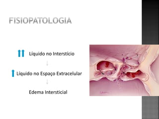 Líquido no Interstício


Líquido no Espaço Extracelular


     Edema Intersticial
 