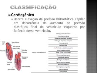  Cardiogênico
    Ocorre elevação da pressão hidrostática capilar
     em decorrência do aumento da pressão
     diastólica final do ventrículo esquerdo por
     falência desse ventrículo.
 